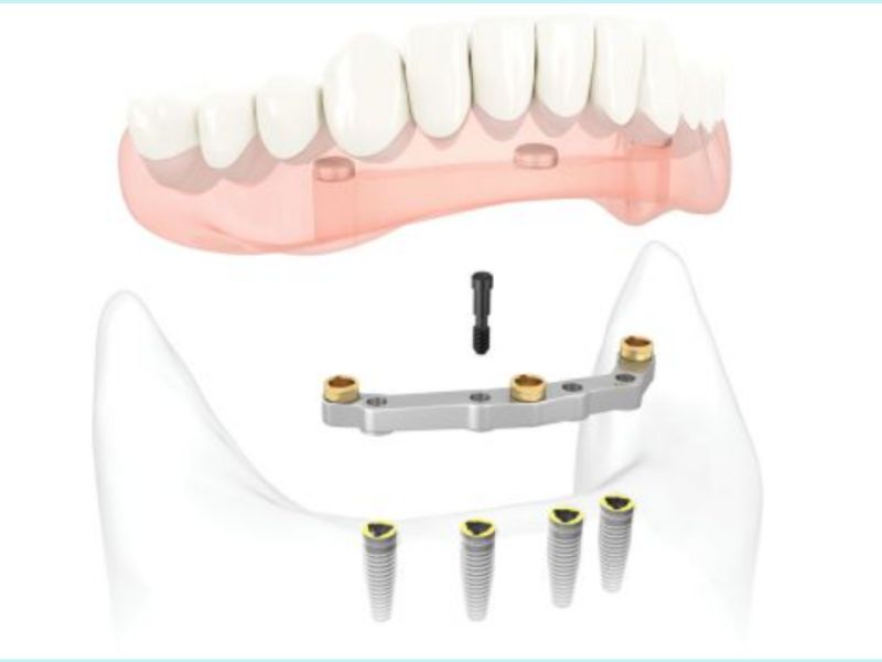 Phục hình tháo lắp hàm trên Implant