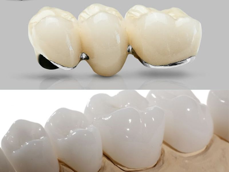 Răng sứ kim loại (trên) và răng toàn sứ (dưới)