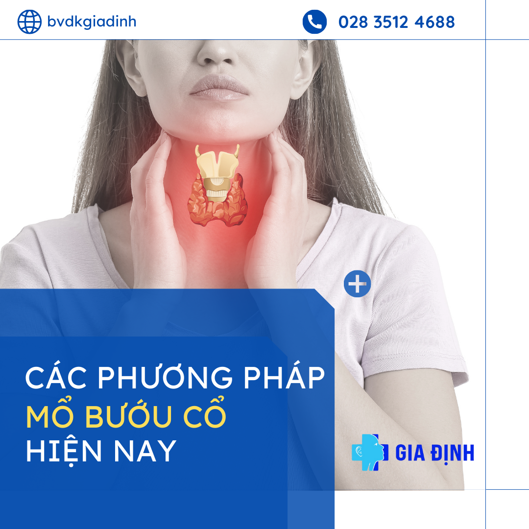 mổ bướu cổ