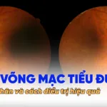avt VÕNG MẠC TIỂU ĐƯỜNG