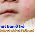 avt Bệnh sốt phát ban