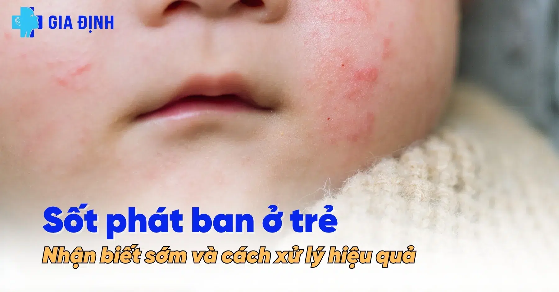 avt Bệnh sốt phát ban