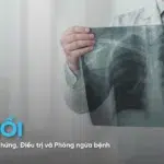 Bệnh xơ phổi